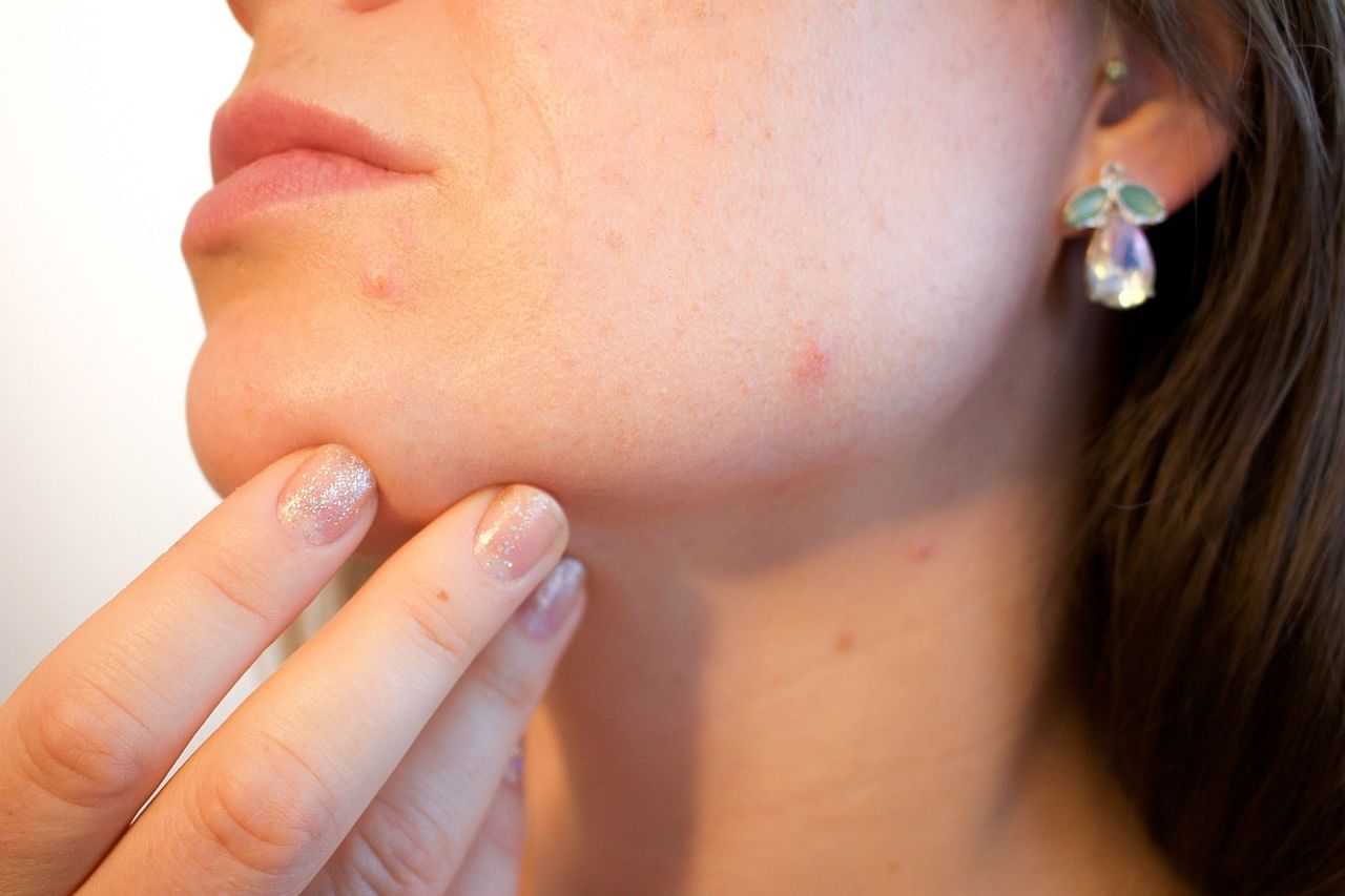 Close-up of a woman examining acne on her face.